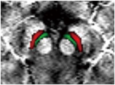 Iron accumulation in the ventral tegmental area in Parkinson's disease